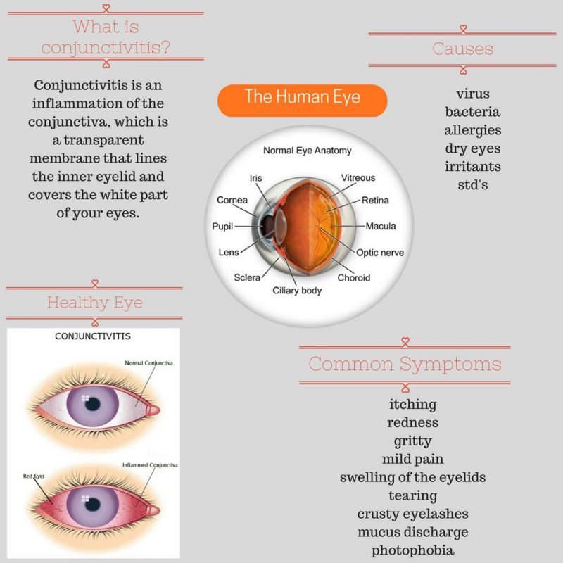 Conjunctivitis - The Eye Practice