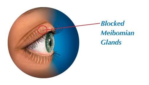 Meibomian Gland Dysfunction The Eye Practice 