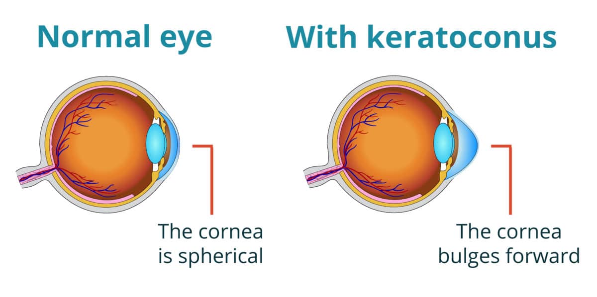 About Keratoconus - The Eye Practice